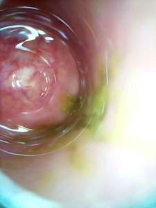 Camera inserted into the asshole to see