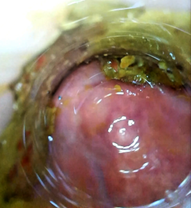 Vaginal + anal endoscopy