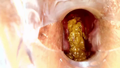 SPECULUM MY ASS POOPO ANAL FARTS PEE