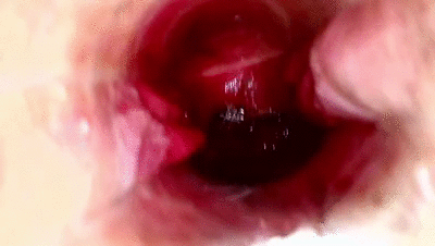 speculum in ass poop pee