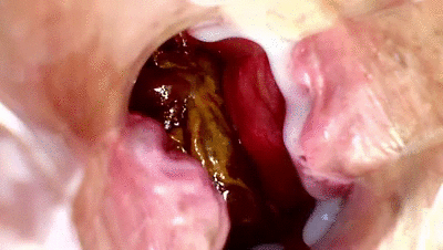 enema speculum anal poop