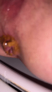 HEAVY DIARRHOEA PROLAPSE