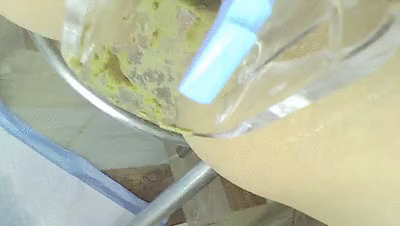 ANAL WITH ENDOSCOPIO FARTS PEE