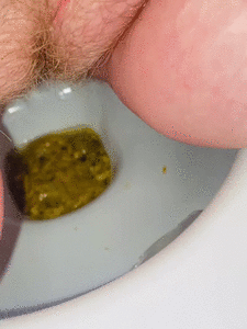 Diarrhea